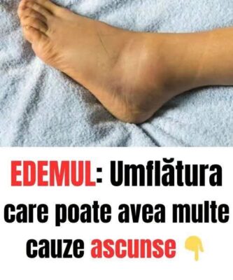 MULȚI OAMENI ignoră picioarele umflate, deși acest simptom indică o afecțiune gravă de…